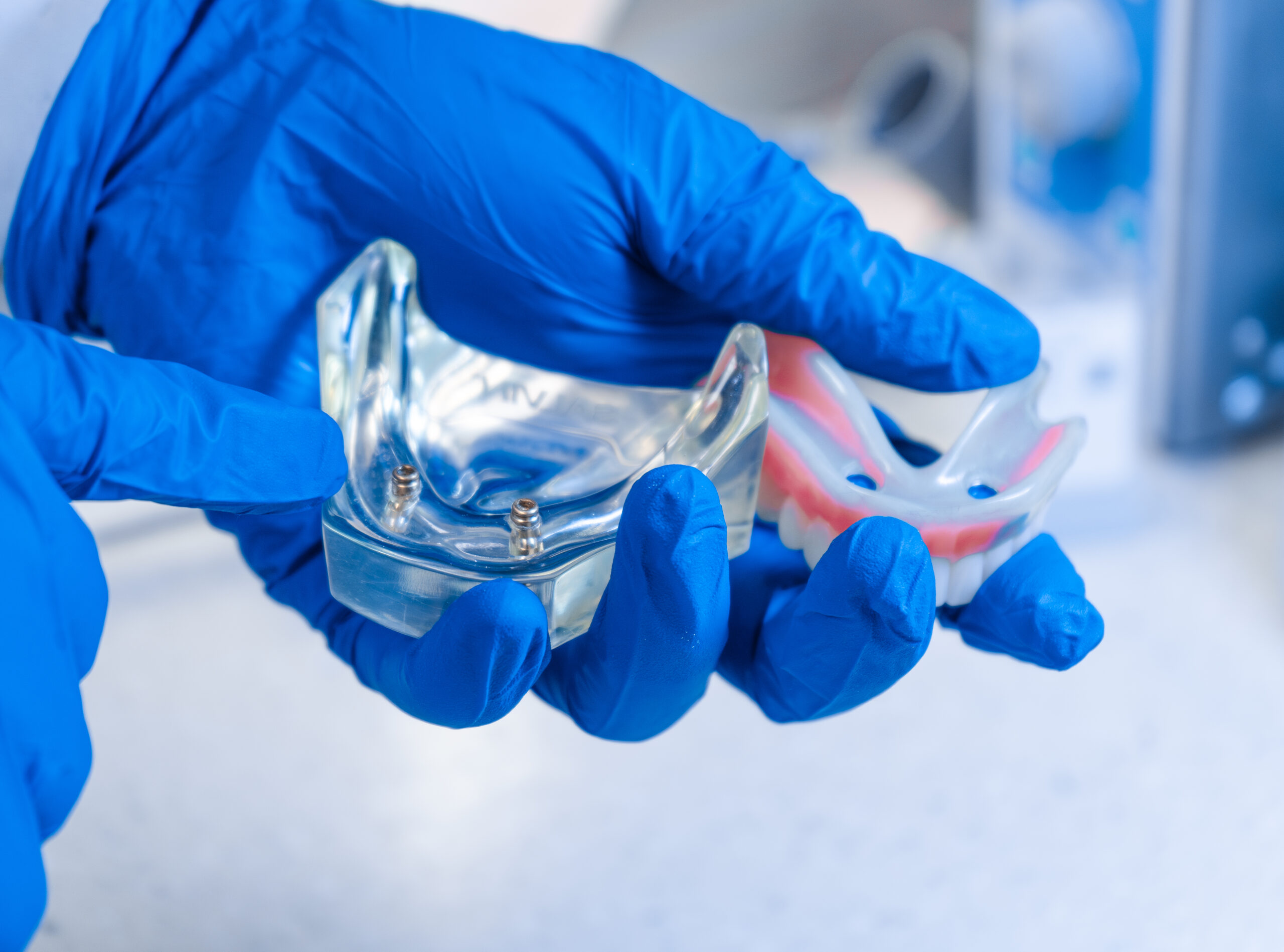 Revolutionize Your Smile: Our Approach to Partial or All on 4 Dentures