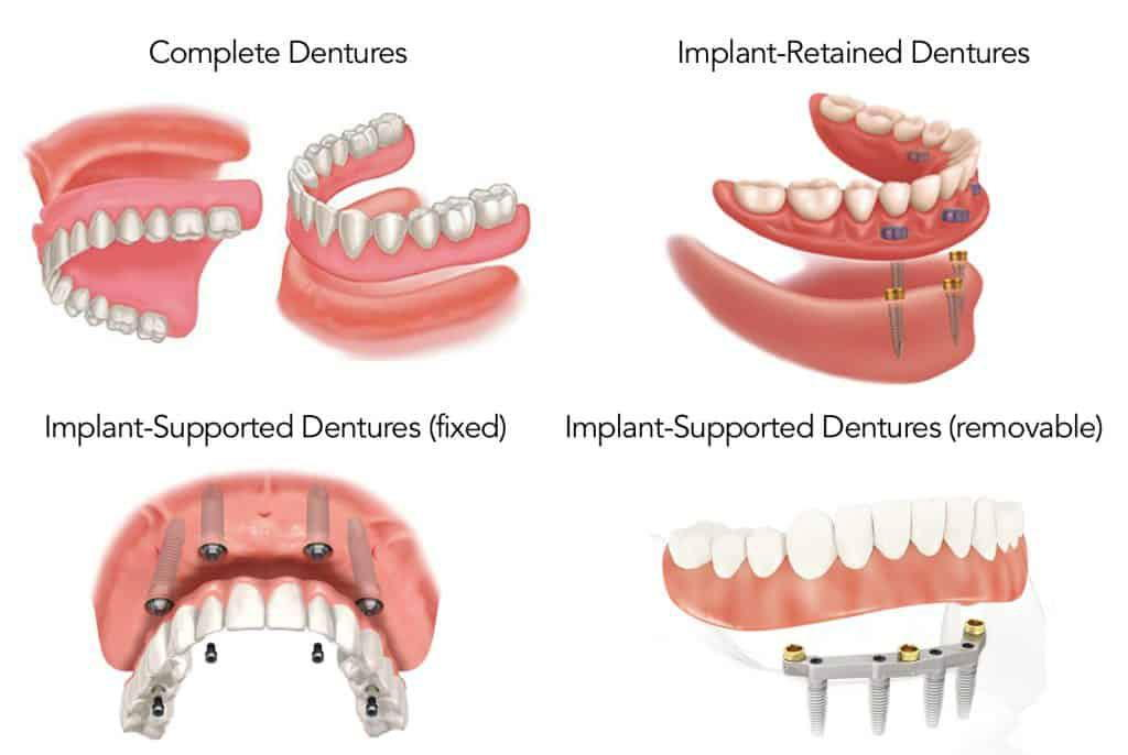Image showing the types of dentures available: complete, implant-retained, implant-supported fixed, and implant-supported removable.